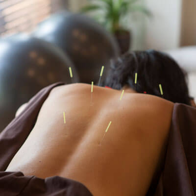 Dry Needling - 1